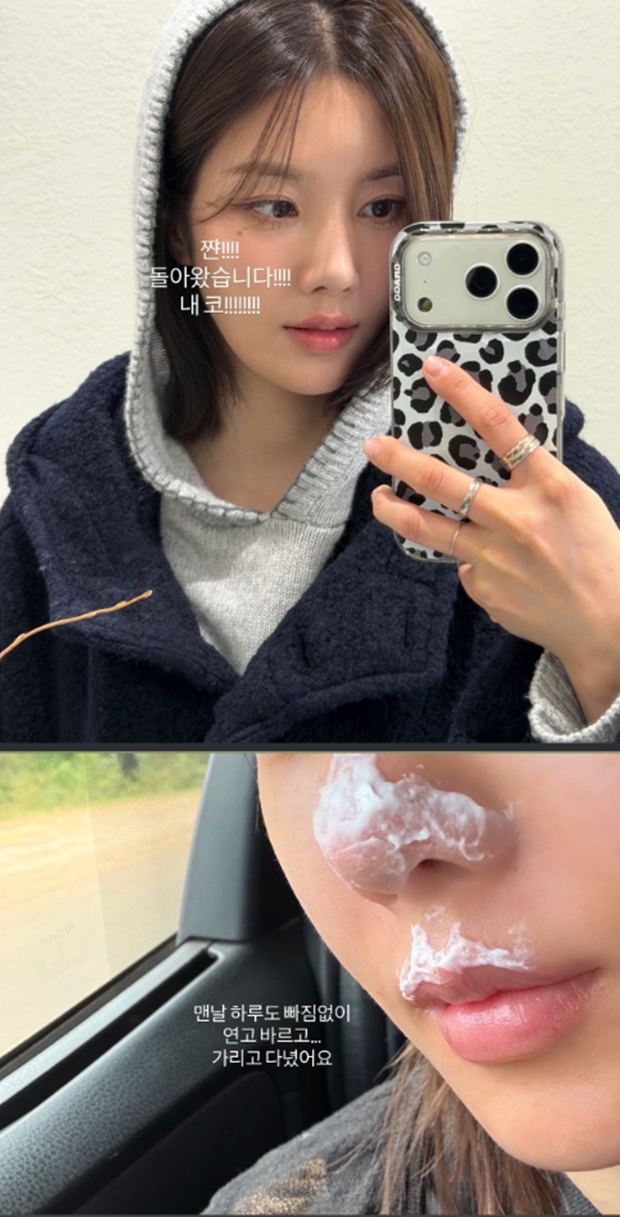 Eunbi Kwon Reveals Second-Degree Burns After Kilimanjaro Climb